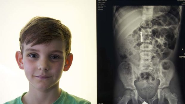 Seven-year-old Joel Smith poses after surgery with an X-ray showing the six magnets that he swallowed.
