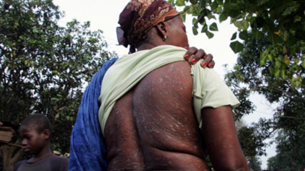 Legal fight...a woman show skin damage that she says was caused by the dumping of toxic waste in Abidjan.