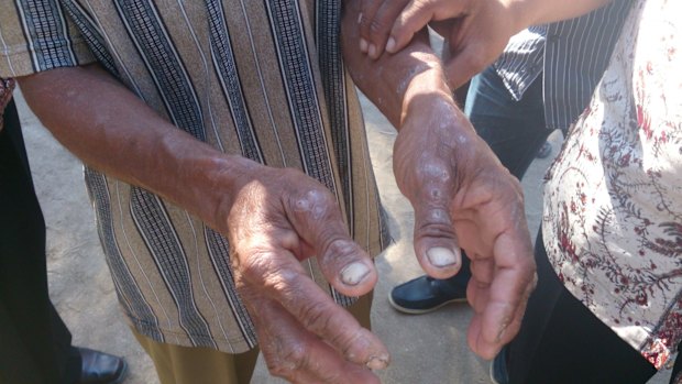 The hands of a man in Indonesia's East Nusa Tenggara province in August 2013. People in the region complain of itchy skin conditions, possibly connected to the spill.