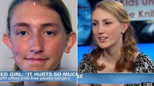 Drastic action ... Nadia Isle, 14, before her surgery, left, and after.
