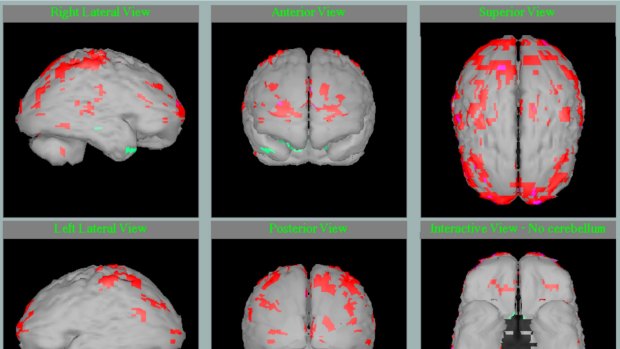 The brain scan of a six-year-old boy who experienced severe neglect and abuse in the first two years of his life. The areas in red show where the brain is not functioning normally. 