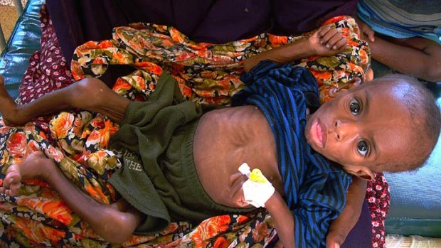A severely malnourished displaced Somali child is admitted at southern Mogadishu's Banadir hospital for treatment.