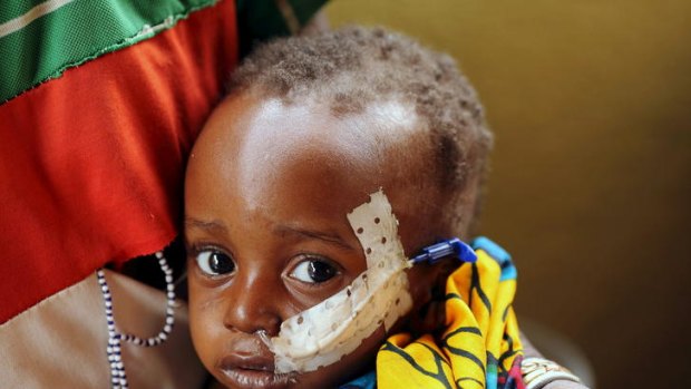 Two-year-old Ouobra Kompalemba, who suffers from severe malnutrition and bronchitis, receives milk through a catheter in a hospital in Diapaga, eastern Burkina Faso.