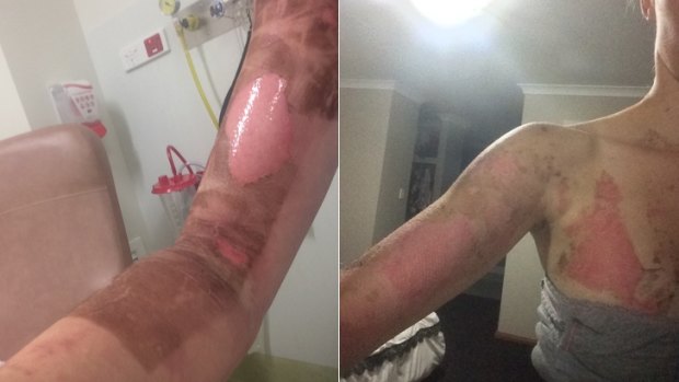Burns suffered by Danika Jones in Perth, after a her Thermomix allegedly burst open when in use, in March this year.