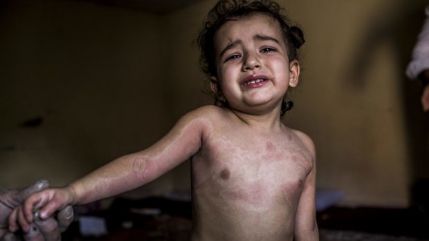 Shadad, Abu Anas's surviving daughter who carries the scars of a chemical weapon attack on her home in Marea, Syria.