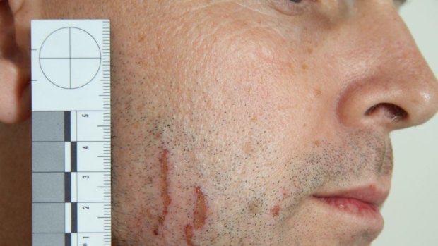 A photograph showing the scratches on Gerard Baden-Clay's face.