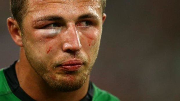 Double fracture: Sam Burgess played on with a fractured cheekbone and eye socket.