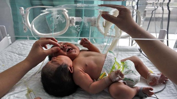 Twin baby girls with a single body and two heads have been born in  China.