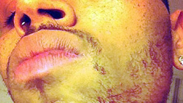 Singer Chris Brown posted a picture of his injuries on Twitter.