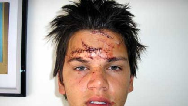 Slashed .... Kent Thomas, 19, who was the victim of a glassing attack in South Melbourne.