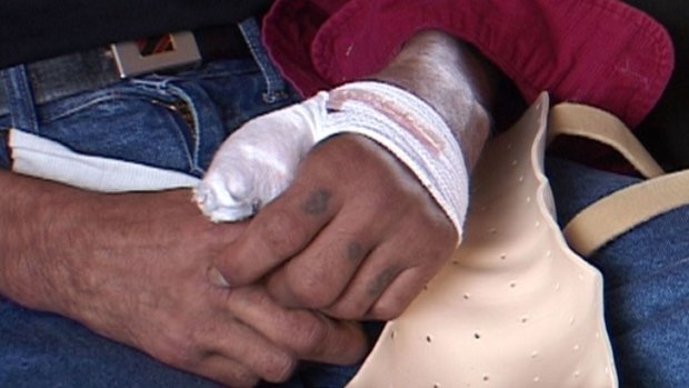 Mr Farmer's hand remains bandaged as he waits for news from doctors about what may happen to his hand.