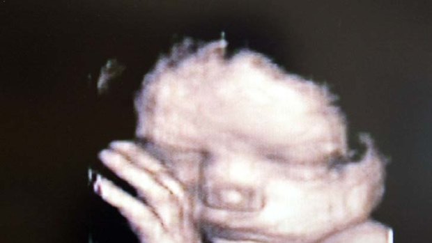 In utero ... a 3D ultrasound.