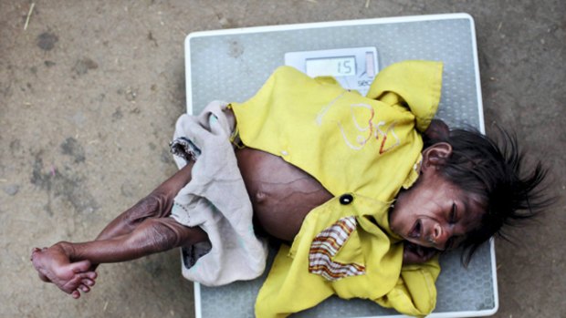 Four-month-old  Ujala weighs 1.5 kilograms, a third of what she should according to the World Health Organisation.