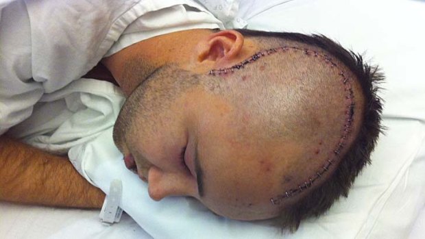 The scar where Simon Cramp had surgery.