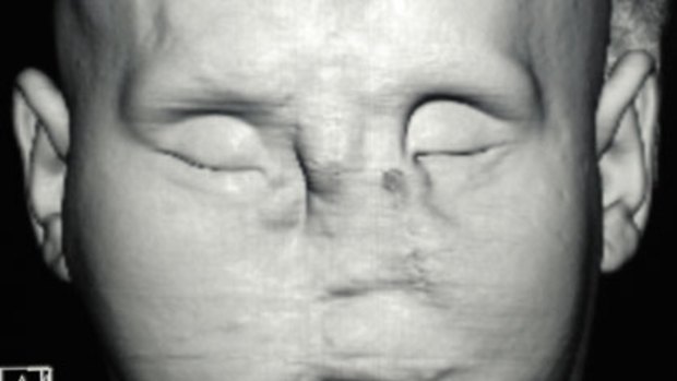 A magnetic resonance image of a man who underwent a full-face transplant before the surgical procedure was performed.