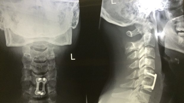Reminder: Keith Lulia’s X-ray showing the metal plate in his neck.