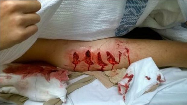 Wounds on Cooper Allen's leg after being bitten by a shark at Lighthouse Beach in Ballina in September. 