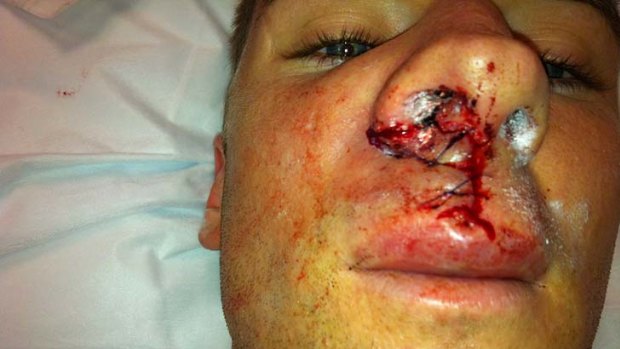 Shane Smeltz's wife Nikki posted a photo of the Perth's star striker's injured face on Twitter.