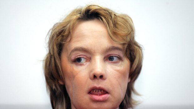 Isabelle Dinoire, the woman who received the world's first partial face transplant in an operation in 2005