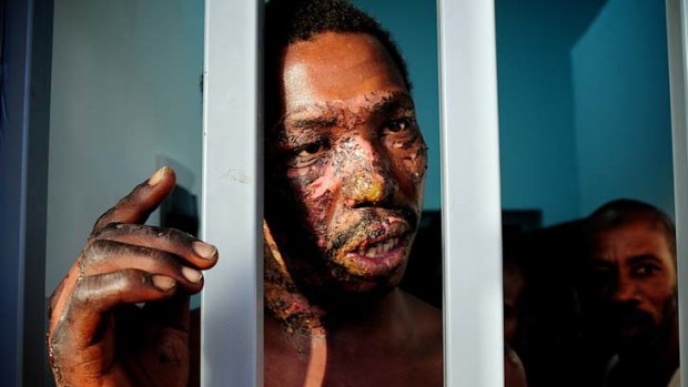 Neglect in custody ... Ahmad Ali stands in his Tripoli prison cell showing the nine-day-old burns to his face that had not received any medical attention.