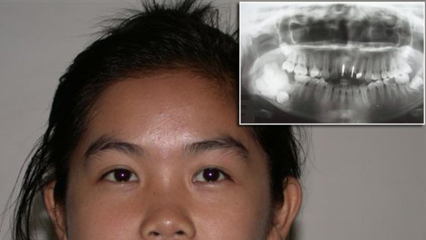 Cambodian girl Sovanna Kak, who is estimated to be 15, has undergone surgery in Brisbane to remove a tumour on her jaw bone (seen in her x-ray inset).