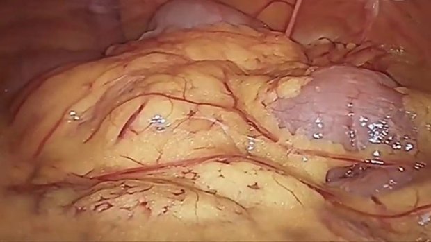 Graphic images of 'toxic fat' will be broadcast across Queensland in a bid to address obesity levels.
