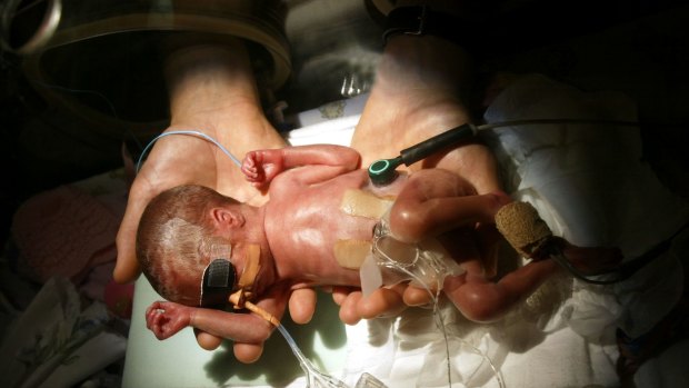 Sophie Capp, who along with her sister Tilly, was born 15 weeks premature.