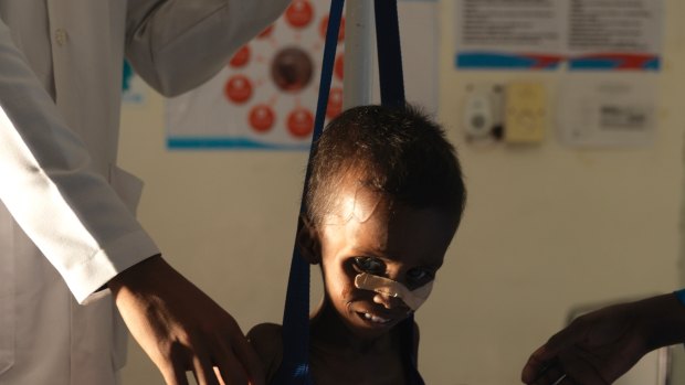 Being weighed. Niman Adan Gabush, 2, is a severe malnutrition case at Hargeisa Group Hospital in Somaliland.