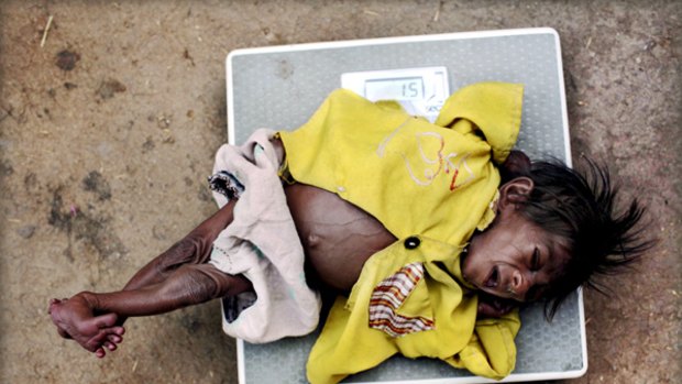 Acute malnutrition ... Ujala is four months old but weighs only 1.5 kilograms.