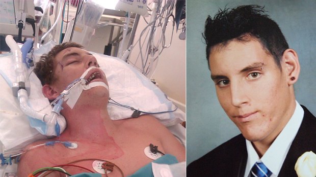 Jamey Barrett, 19, had to be placed in an induced coma after an alleged one-punch attack.