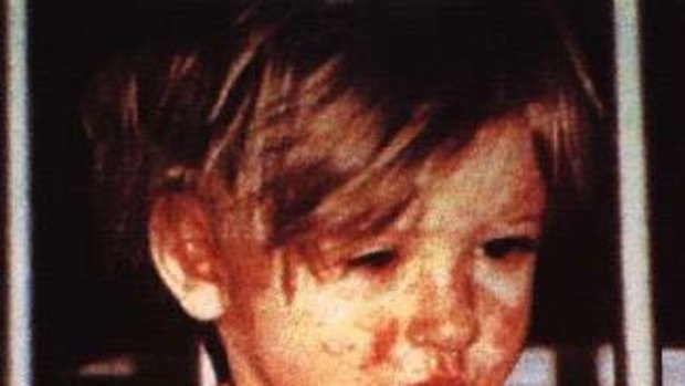 A child sick with measles in Newcastle, 2002. The rash typically starts on the head and neck before spreading across the body.