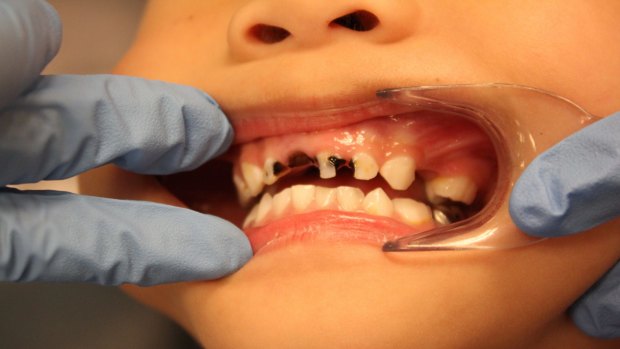 More than one-third of NSW children aged five to 10 have decay in their baby teeth.