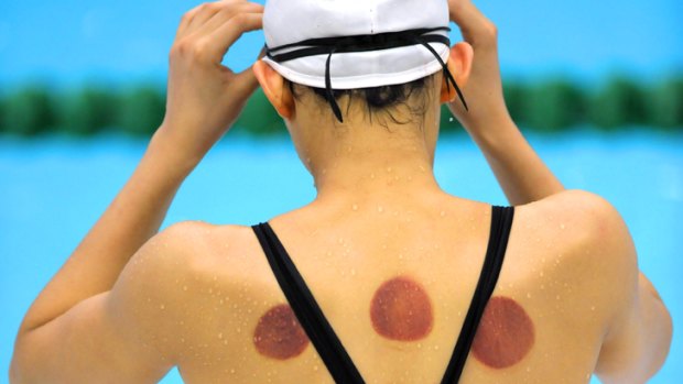 Traditional treatment ... evidence of cupping therapy on the back of Chinese Olympic swimmer Wang Qun at the 2008 Beijing Olympics.