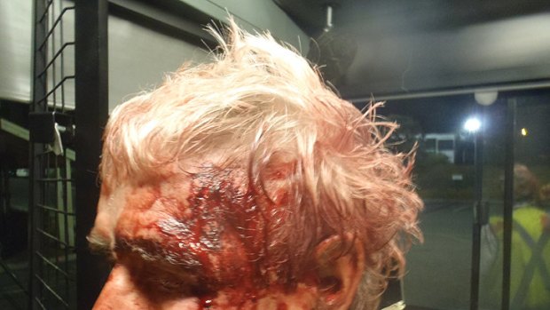 The bus driver's injuries after an unprovoked, two minute attack by a woman.