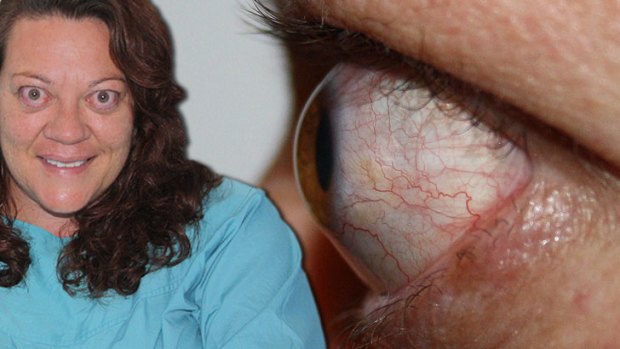 Before a recent operation, an unusual condition caused Lerina Wilson's eyes to stick out more than a centimetre further than that of the average person.