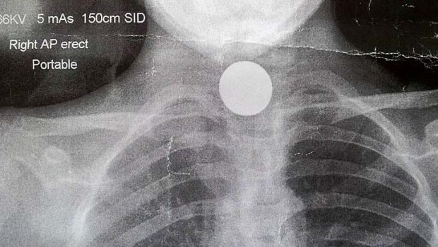 Money shot ... an X-ray shows the coin.