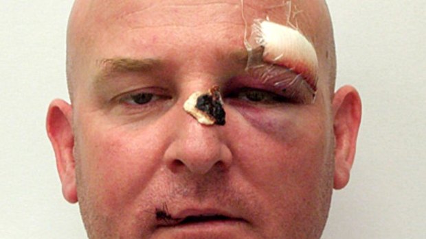 Sergeant Brett Ward after he was allegedly bashed in Melbourne's CBD on Saturday night.