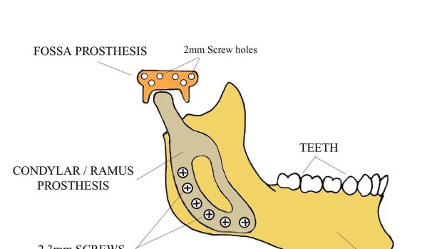 A diagram shows where the jaw prosthesis was inserted. 