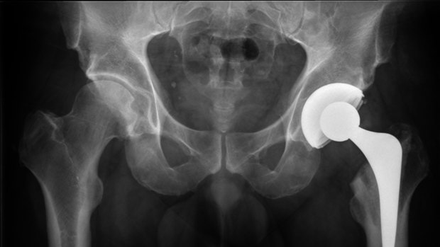 A typical ball and socket artificial hip replacement.