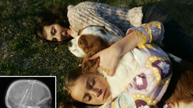 Mystery disorder ... Leanna, left, and Bethany Mills suffer from a rare movement disorder but have been saved by electrodes implanted in their brains. Left: Broken electrode, an X-ray of Leanna's head.