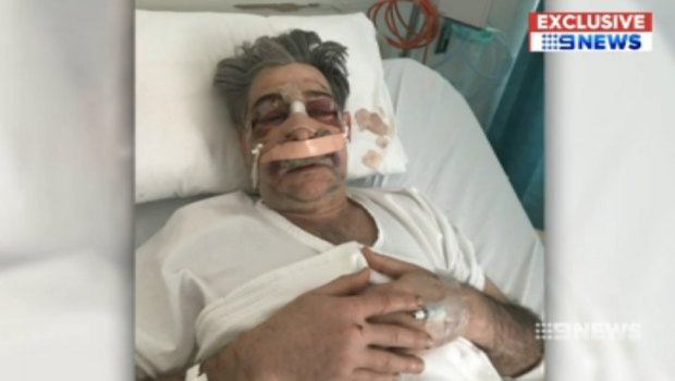 Edmund Pribitkin in hospital after the alleged assault.