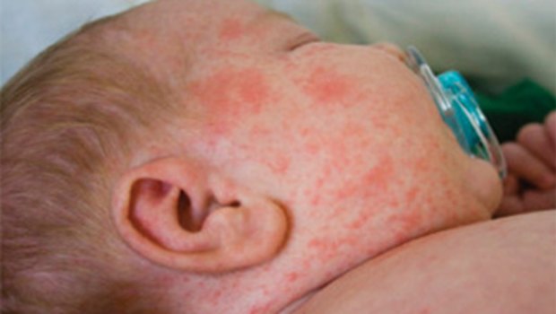 Passengers on a flight from Bali to Australia have been warned to look out for symptoms of measles after a co-passenger was diagnosed on Sunday. 