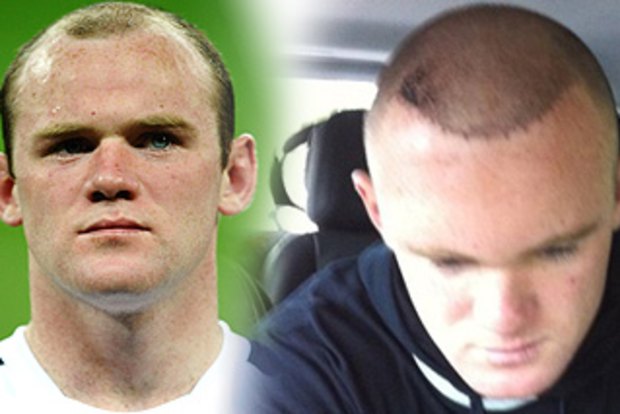 Wayne Rooney reveals new look after hair transplant