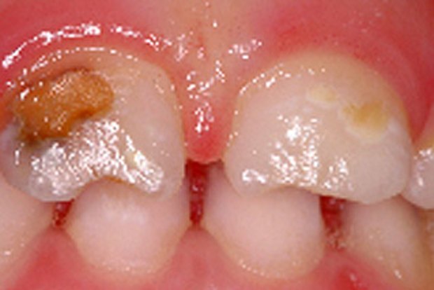 WA toddlers endure multiple tooth extractions