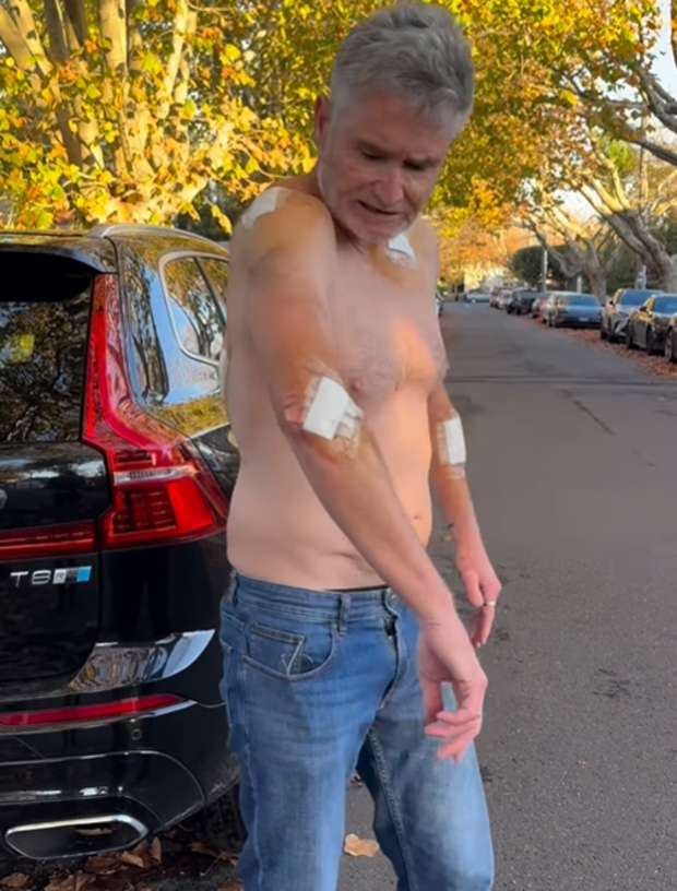 Dave Hughes covered in bandages after having five skin cancers removed