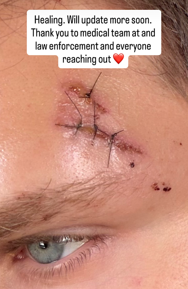Actor Keegan Allen armed robbery injury