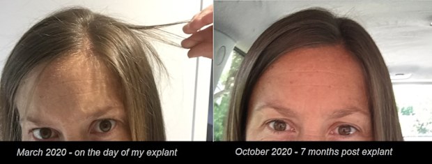Robyn Smith's hair grew thick and healthy again after the explant surgery.