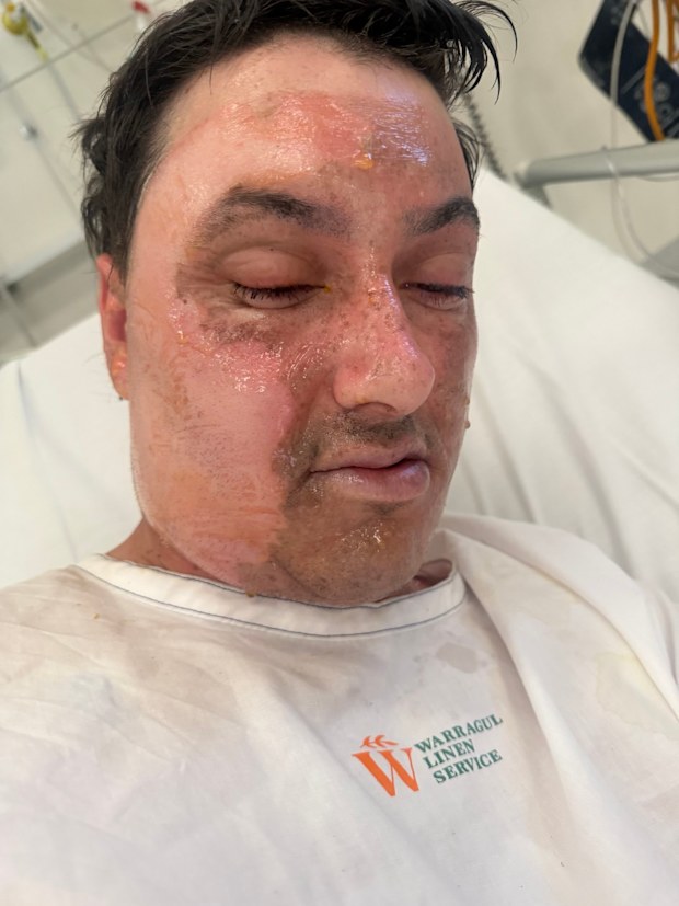 Trent Woolman has spoken out about his horror accident bonfire love island australia