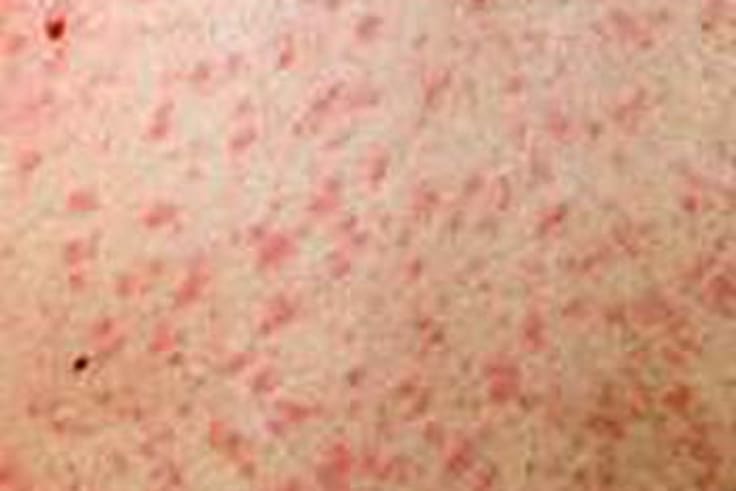 rail-commuters-warned-to-be-aware-of-measles-symptoms-after-third-case