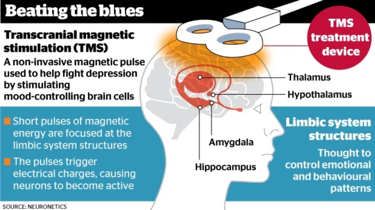 Is Transcranial Magnetic Stimulation Prozac?